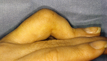 contracture-finger
