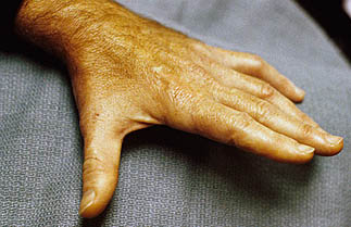 cubital-tunnel-syndrome